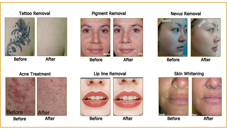 A series of photos showing different stages of lip line removal.