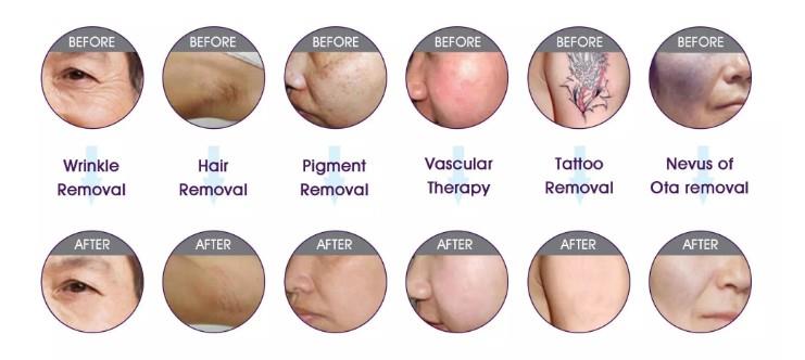 A series of pictures showing different stages of tattoo removal.