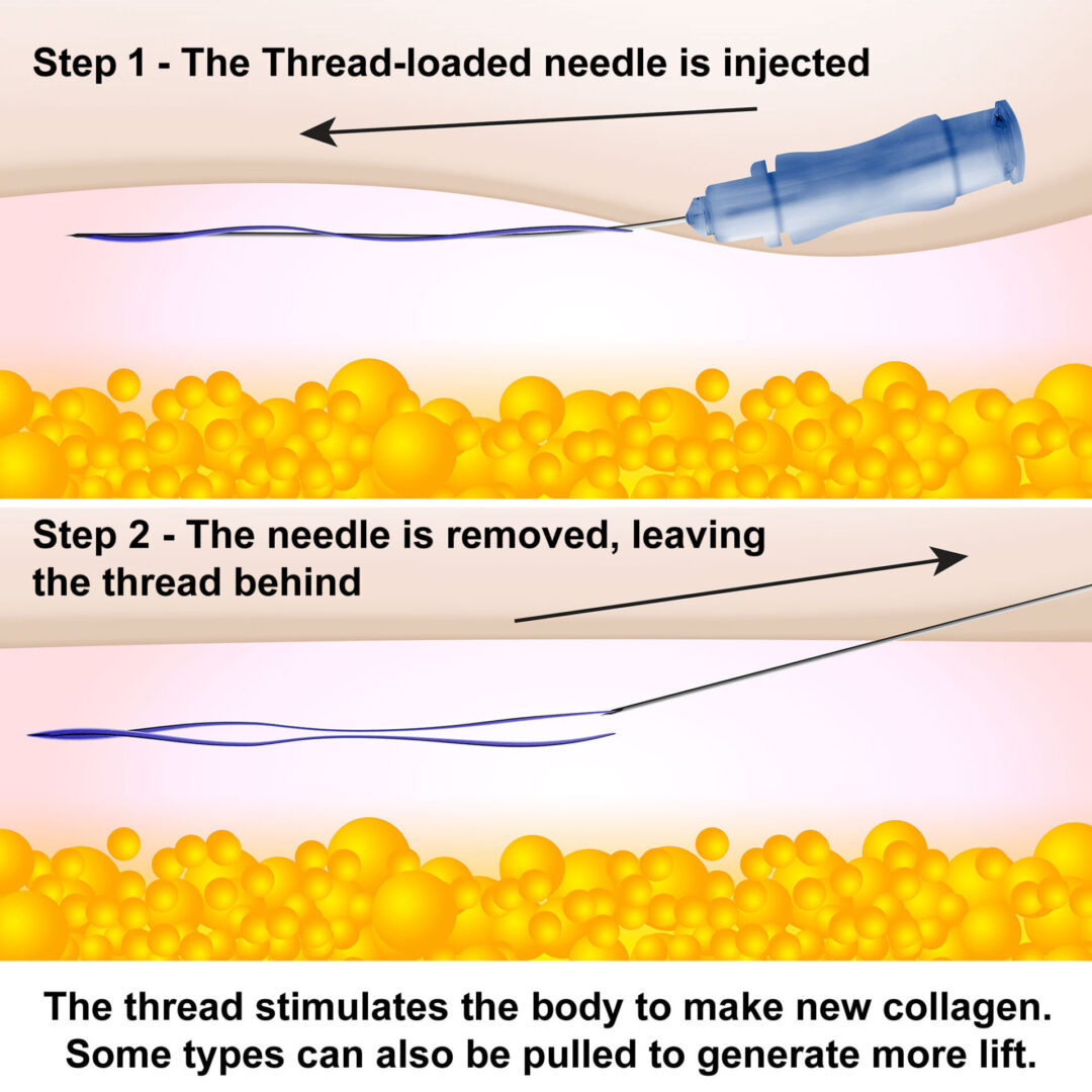 A diagram of how to make collagen injections.
