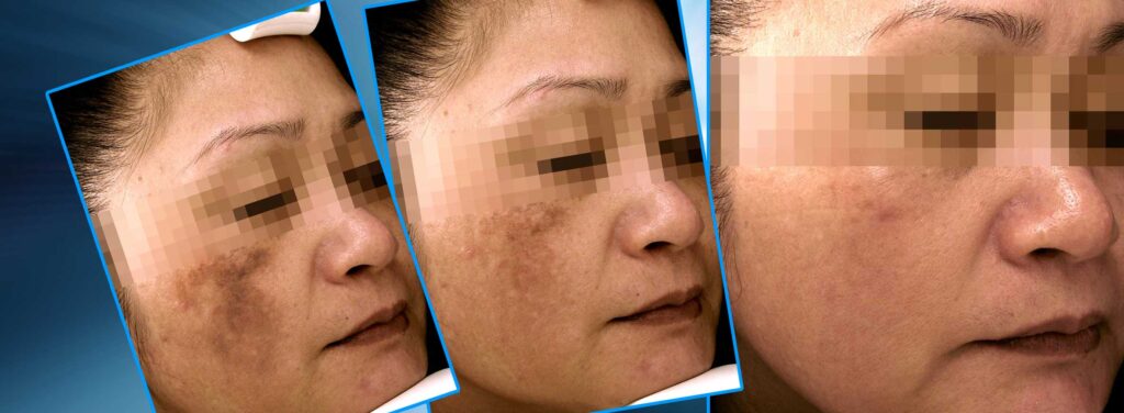 A woman with brown spots on her face.