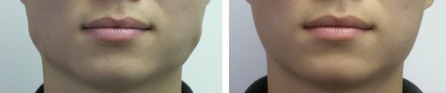 A before and after picture of the neck area.
