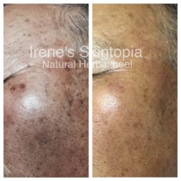 A before and after photo of the skin on an older person.