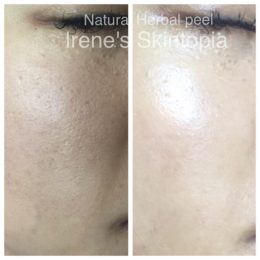 A before and after photo of the skin