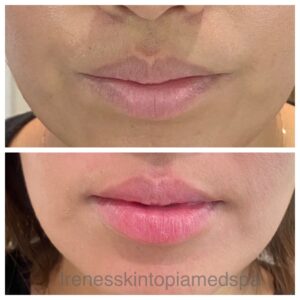 A before and after picture of the lips