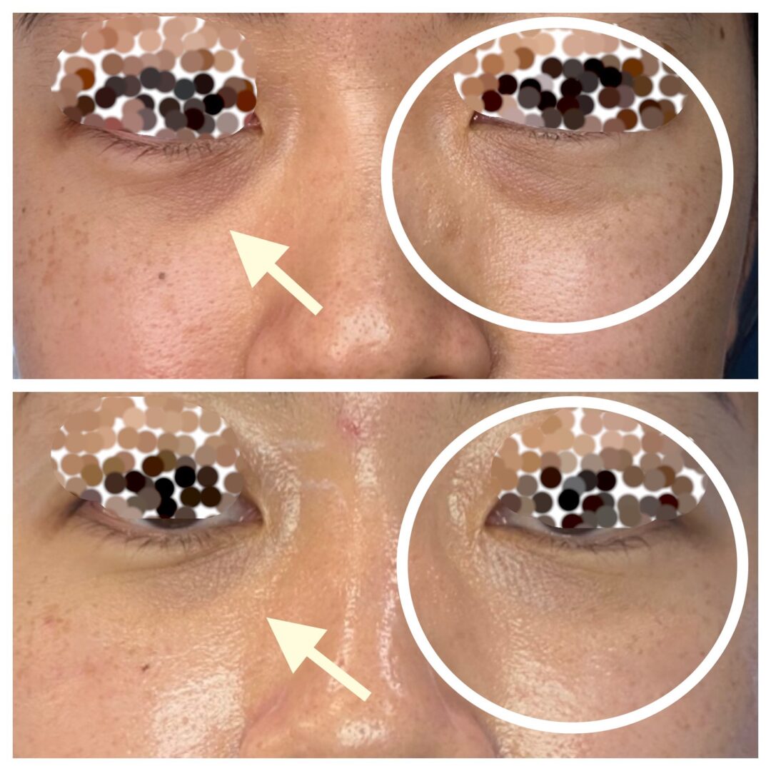 A woman 's eye with two different images of the same image.