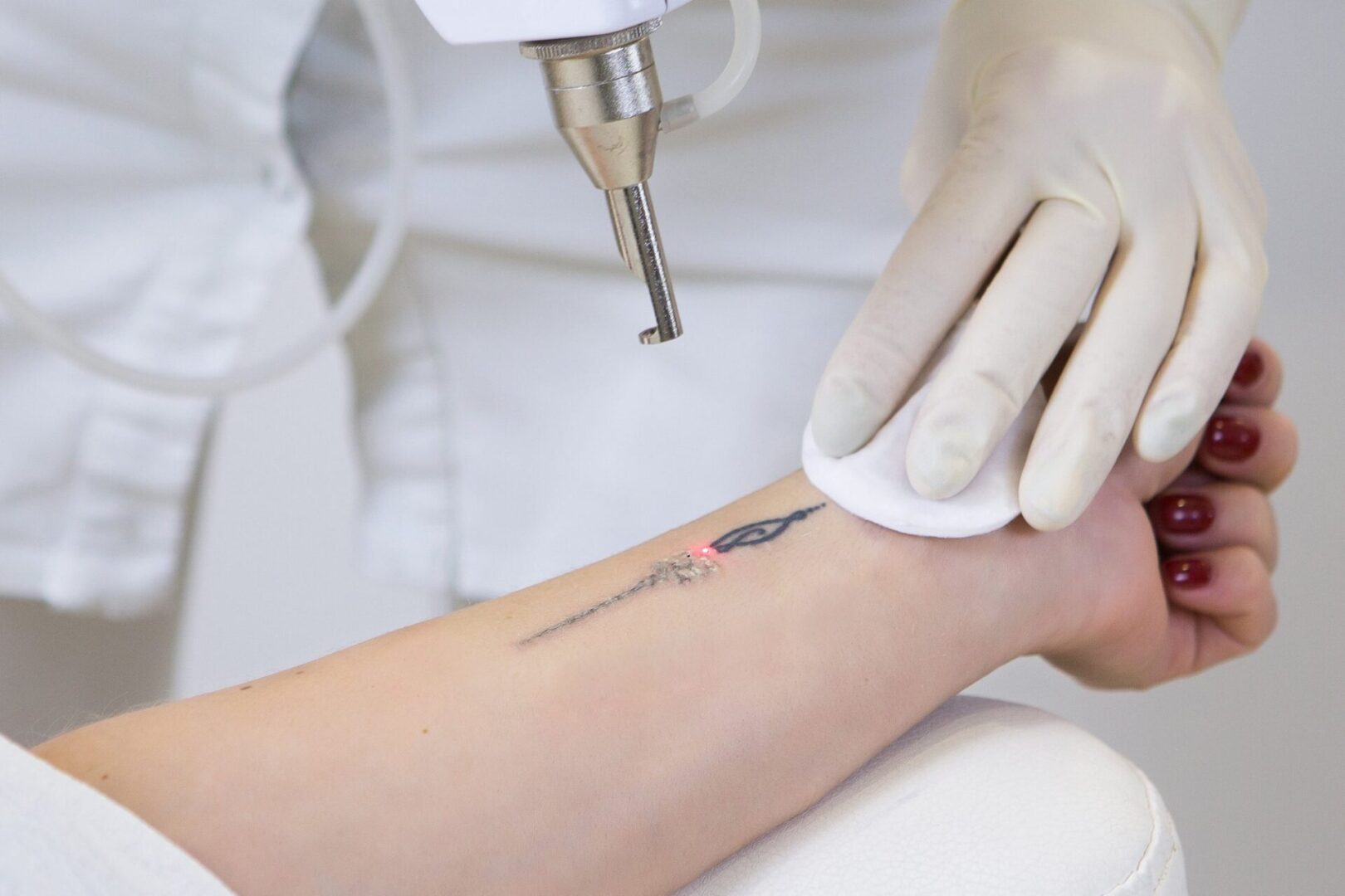 how-does-laser-tattoo-removal-work