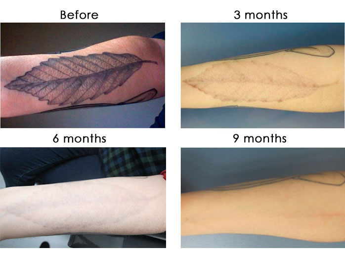 laser-tattoo-removal-image-nyc-new