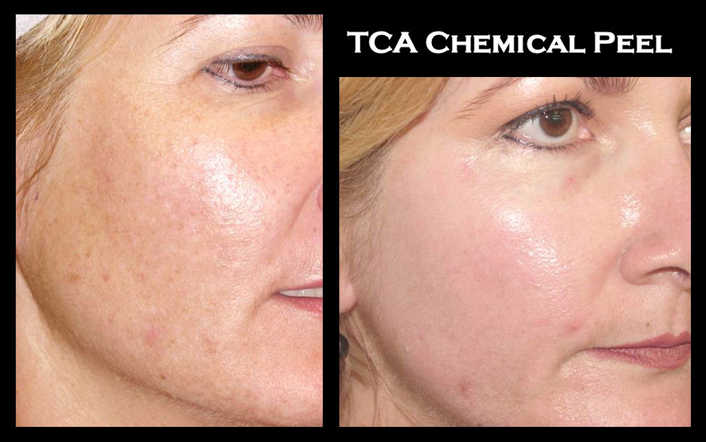 A woman 's face before and after chemical peel.