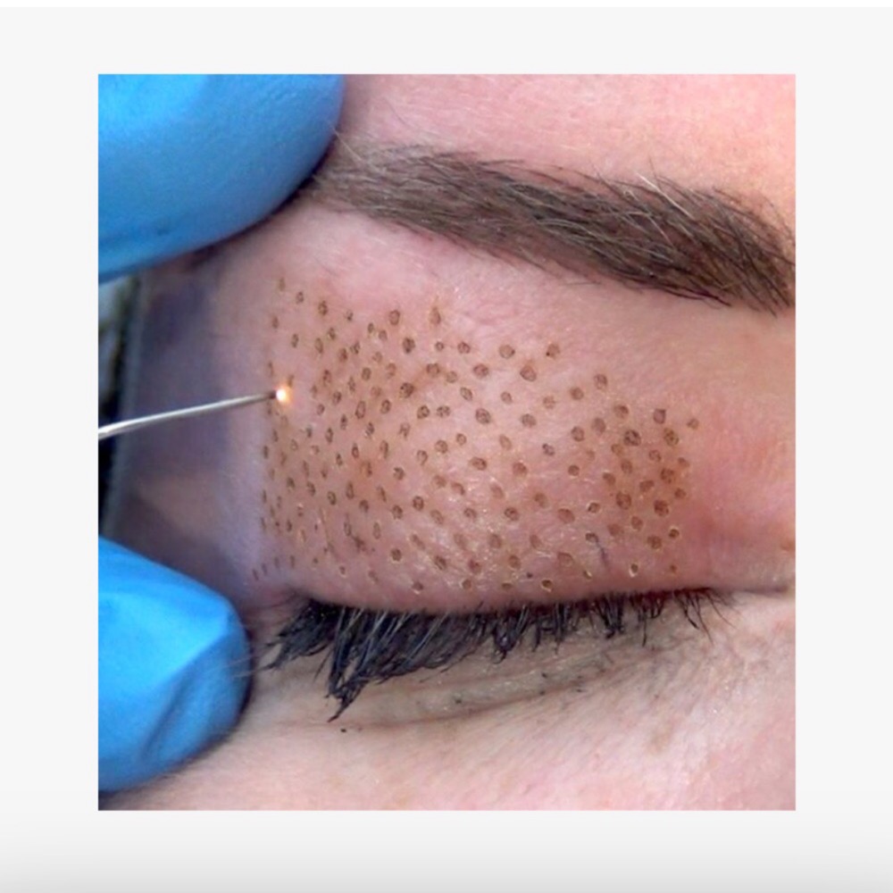 A person is using a needle to remove the brown spots from their eye.