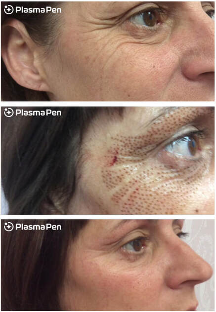 A woman with various stages of blepharoplasty surgery.