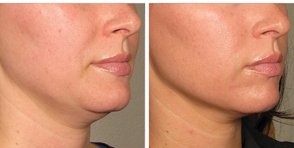 ultherapy_before_and_after_120days_jowels_3