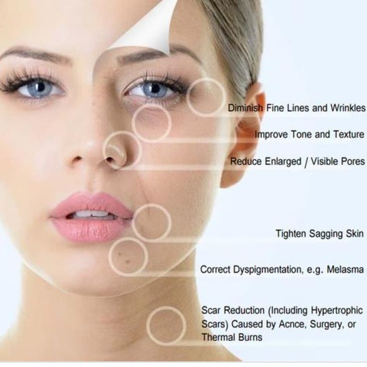 A woman with circles around her face and the words " dermaplaning ".