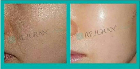 Rejuran_before__after_1